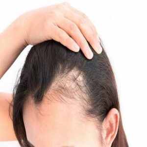10 روش درمان ریزش مو زنانه