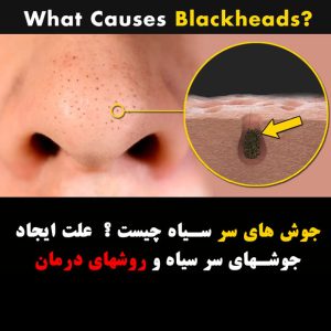های سر سیاه چیست ؟ 6 علت ایجاد جوشهای سر سیاه و روشهای درمان 300x300 - سوالات متداول در خصوص سرم ضد جوش