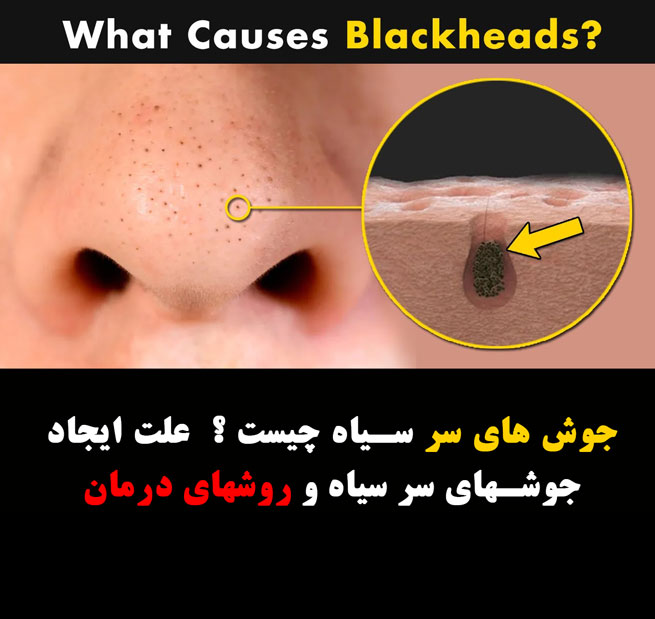 های سر سیاه چیست ؟ 6 علت ایجاد جوشهای سر سیاه و روشهای درمان - جوش های سر سیاه چیست ؟ 6 علت ایجاد جوشهای سر سیاه و روشهای درمان
