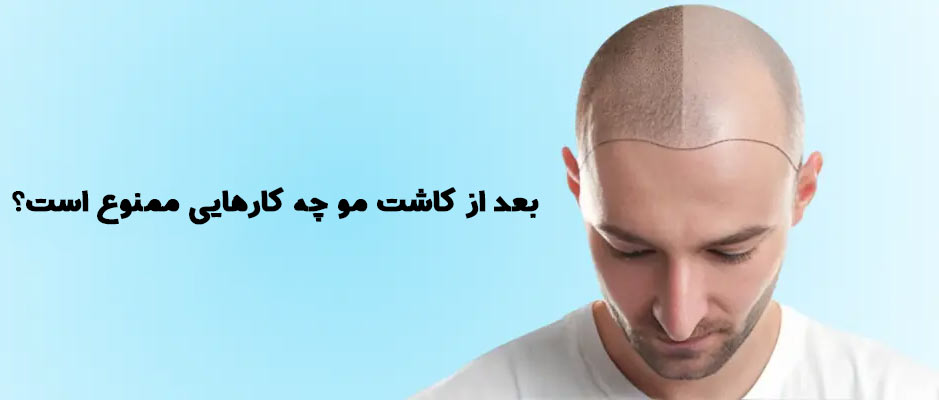 بعد از کاشت مو چه کارهایی ممنوع است؟