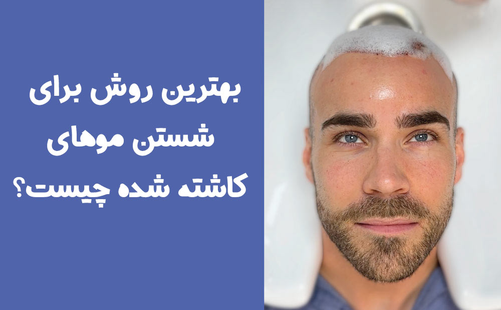 بهترین روش برای شستن موهای کاشته شده چیست؟