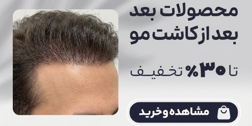 کاشت مو - صفحه نخست